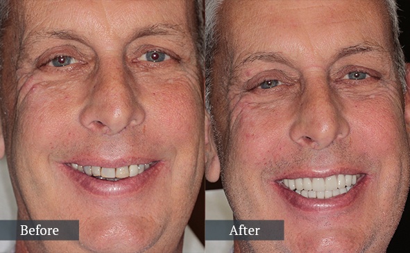 Veneers Before and After